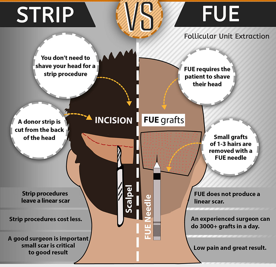 Strip Fut Vs Fue Hair Transplant Hair Growth Methods