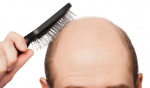 Cost of hair loss surgery abroad
