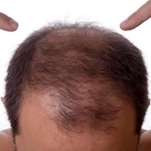 Hair loss tips tricks
