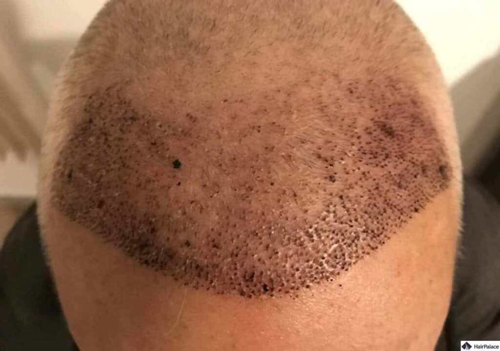 Hair transplants recovery time and healing