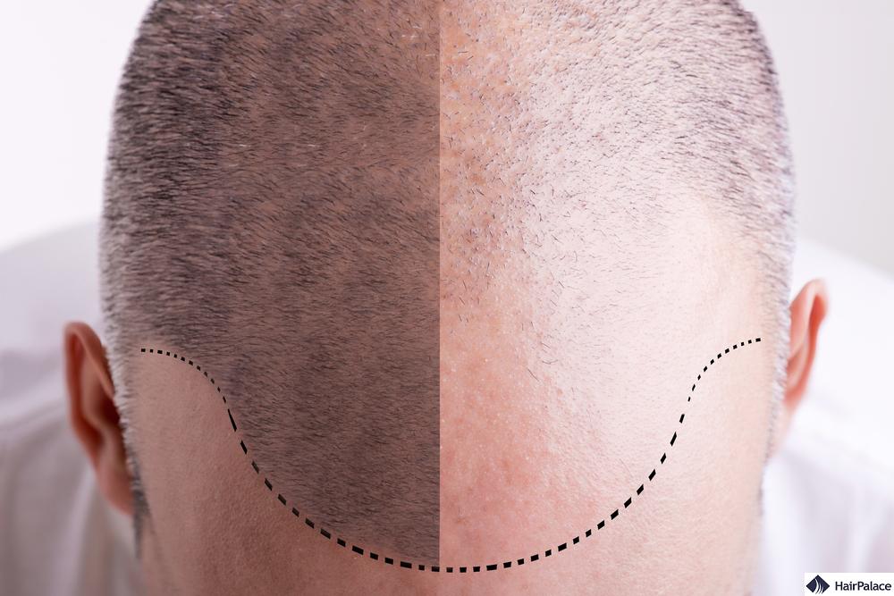 Hair transplant surgery