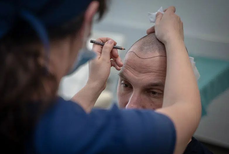 Hair transplants abroad: Budapest, Hungary