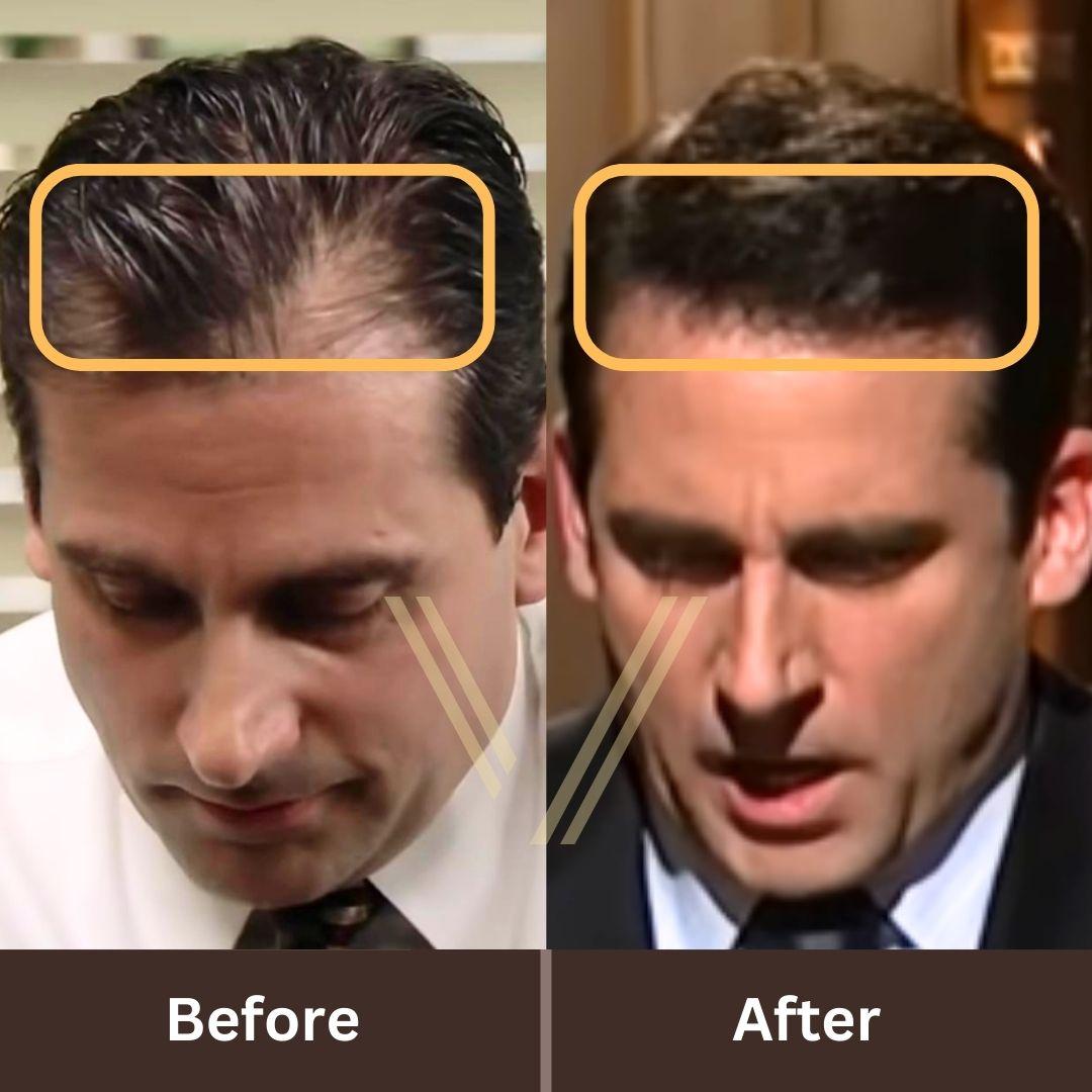 Steve Carell before and after hair transplant showing improved hairline and density
