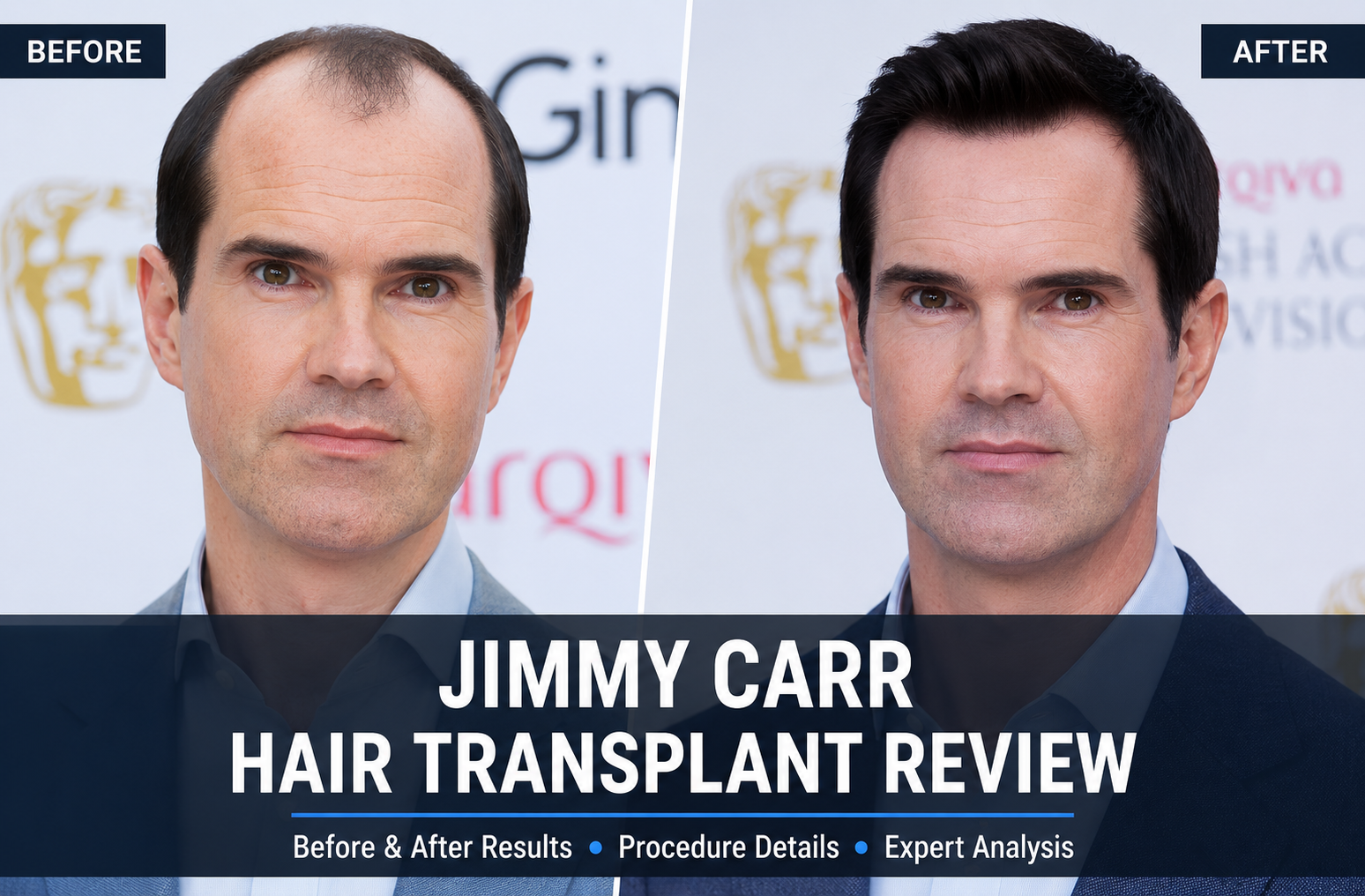 Jimmy Carr hair transplant before and after comparison showing natural FUE hairline restoration and celebrity hair transplant results in the UK